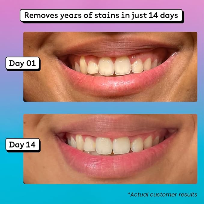 Whiitely Teeth Whitening Pen